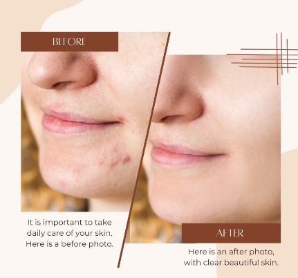 Blemish Repair (Spot Treatment)