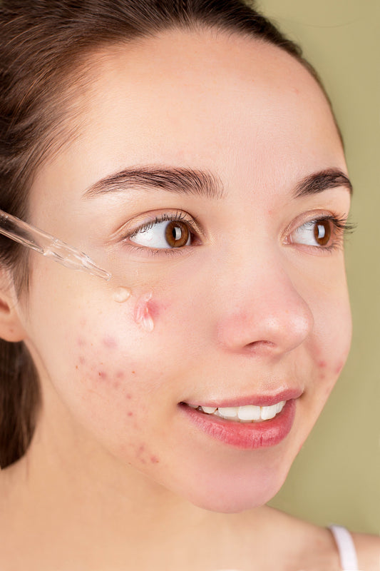 The four common skin conditions: acne, rosacea, eczema, psoriasis