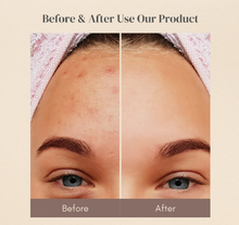 Load image into Gallery viewer, Reduce Acne: Skin Calming Spot Treatment
